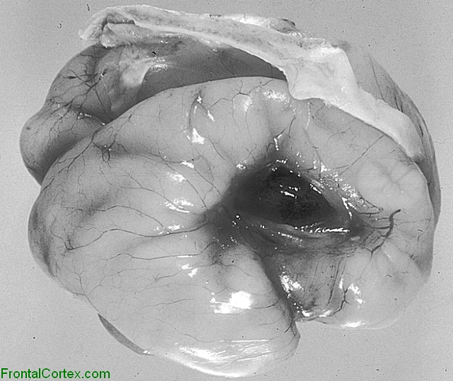 Schizencephaly, lateral surface of brain.